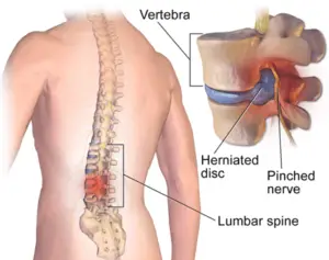 Spinal Disc Strain