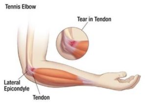 ping pong elbow injury